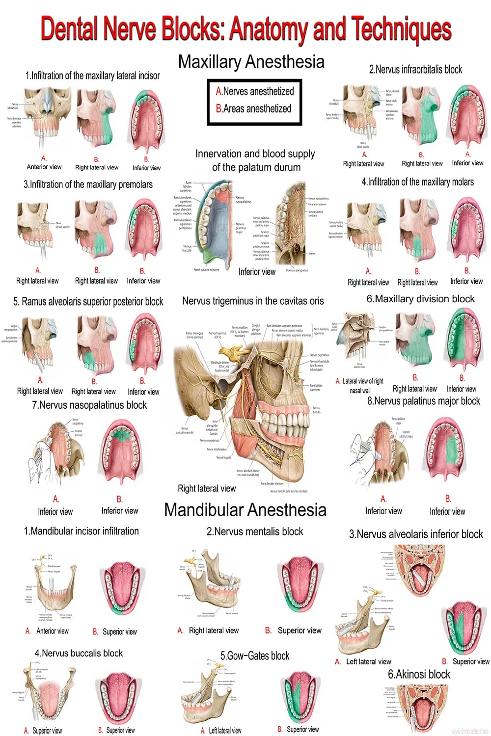 Dental nerve blocks poster main view with maxillary and mandibular anesthesia techniques