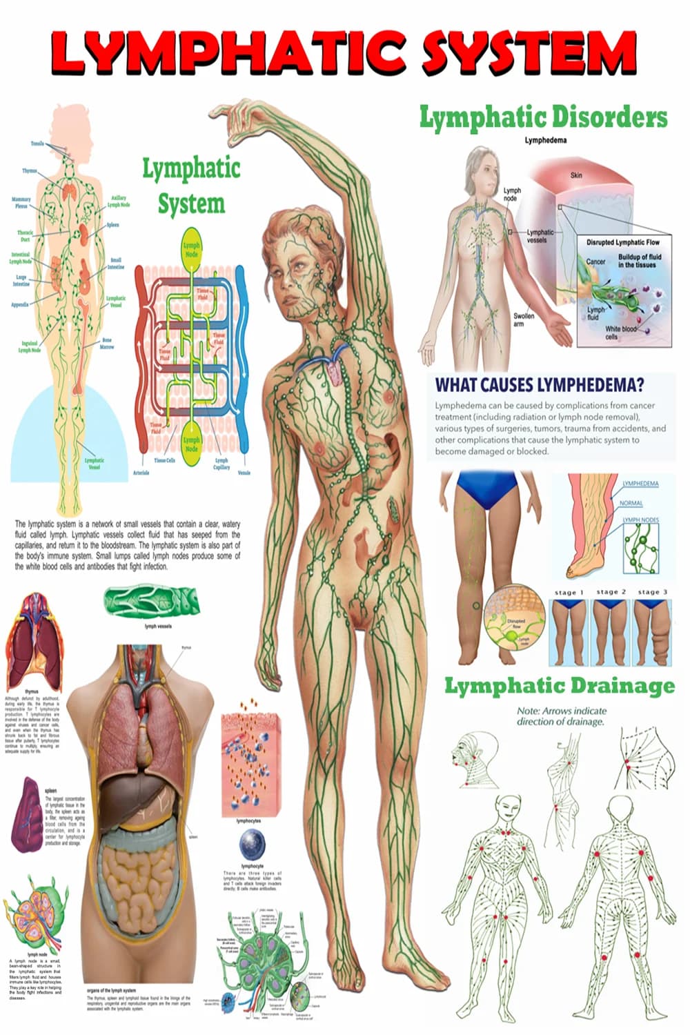Lymphatic system poster main view with anatomy, lymphedema stages, and drainage map
