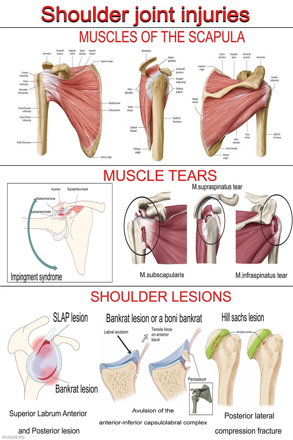 Poster showing shoulder joint injuries including rotator cuff tears and labral lesions
